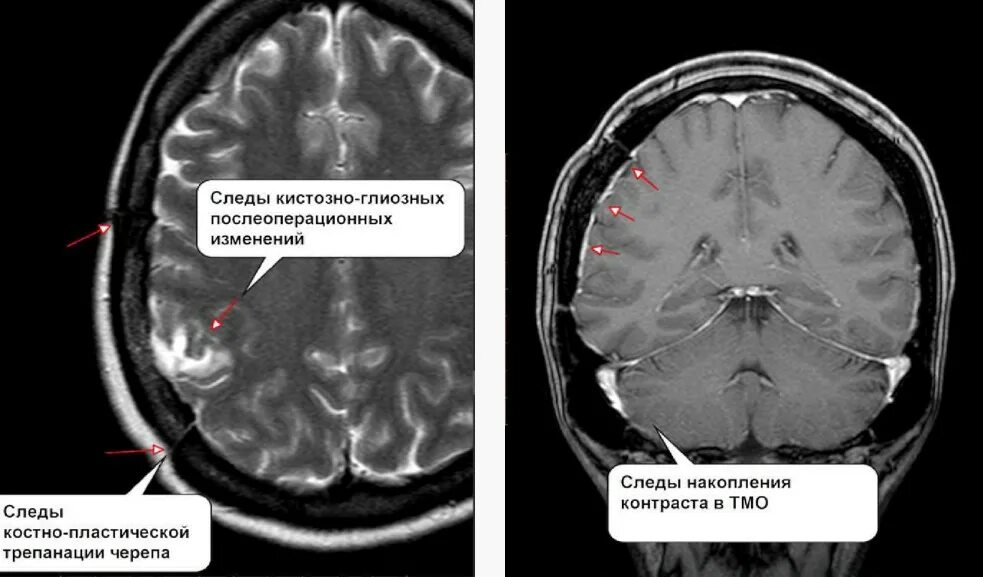 Мрт результаты сразу. Кистозно-глиозные изменения мрт. Мрт ГМ норма. MRT головного мозга Norma. Как выглядит расшифровка мрт.