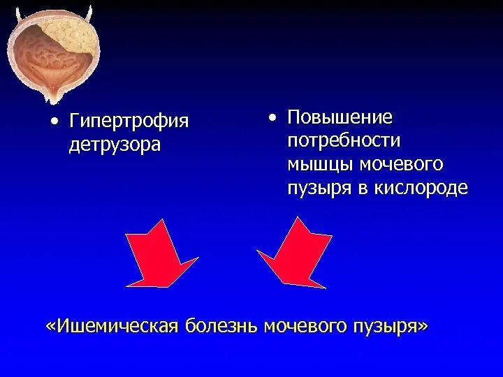 Детрузор мочевого пузыря это. Детрузор мочевого пузыря. Гипертрофия детрузора мочевого пузыря. Мышца детрузор мочевого пузыря. Детрузор мочевого пузыря образован:.