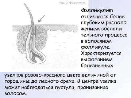 Волосяной фолликул как лечить