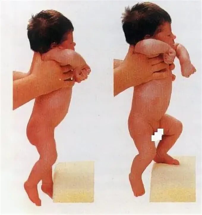 Рефлекс автоматической походки у новорожденного. Рефлекс опоры и автоматической ходьбы новорожденных. Рефлекс опоры у новорожденных. Рефлекс опоры и шаговой.