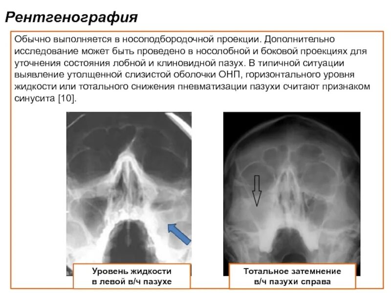 Рентген придаток пазух пневмотизация. Пневматизация ячеек решетчатого лабиринта. Признаки повреждения легкого. Тотальное снижение пневматизации. Тотальное снижение пневматизации.