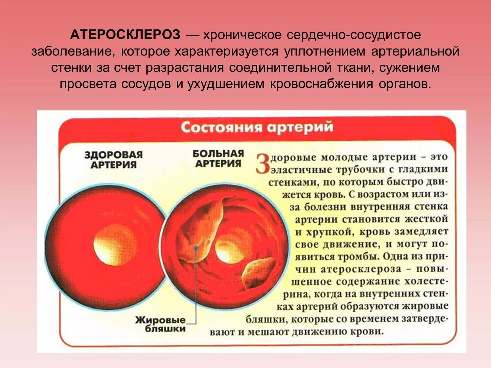 Хроническая сердечная заболевания. Атеросклеротическая болезнь сердца. Атеросколетическая болезньсердца. Атеросклеротическая болезнь се. Атеросклероз сердечно сосудистый.