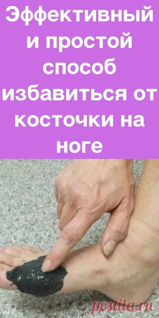 Примочки для косточке на ноге. Лечение шишки на ноге народными средствами. Народные средства от шишки на большом пальце. Средство от косточки на большом пальце. Избавление от косточки на ноге.