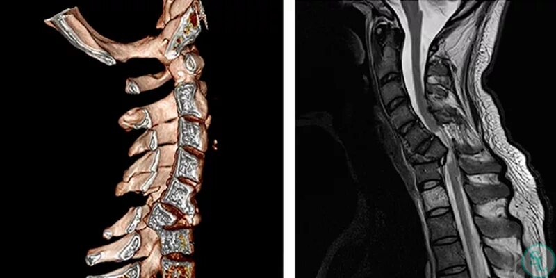 Мрт спинного отдела. Компрессионный перелом позвонков мрт. Компрессионный перелом грудного позвонка мрт. Компрессионный перелом позвонка мрт. Перелом Корешков позвоночника.
