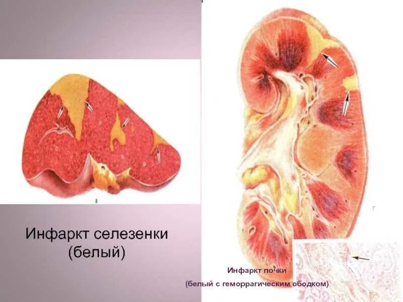 Белый инфаркт почки макропрепарат. Анемический инфаркт селезенки. Анемический инфаркт почки. Анемический инфаркт почки макропрепарат. Распад селезенки