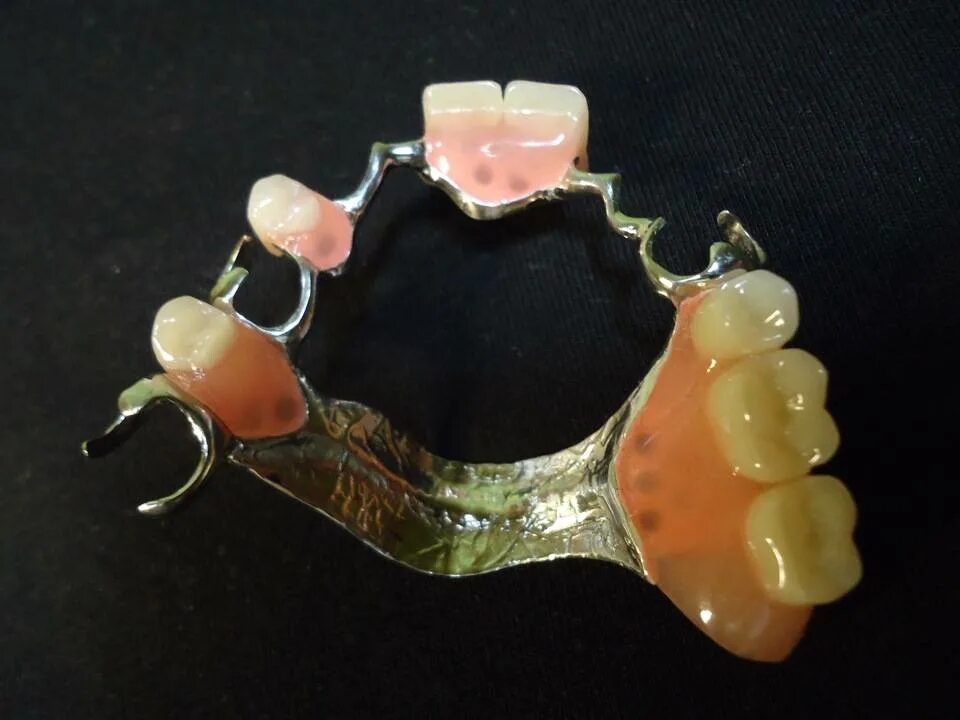 036. Конструкции съемных протезов. Бюгельный протез с замковой фиксацией. Бюгельный мостовидный протез. 001.