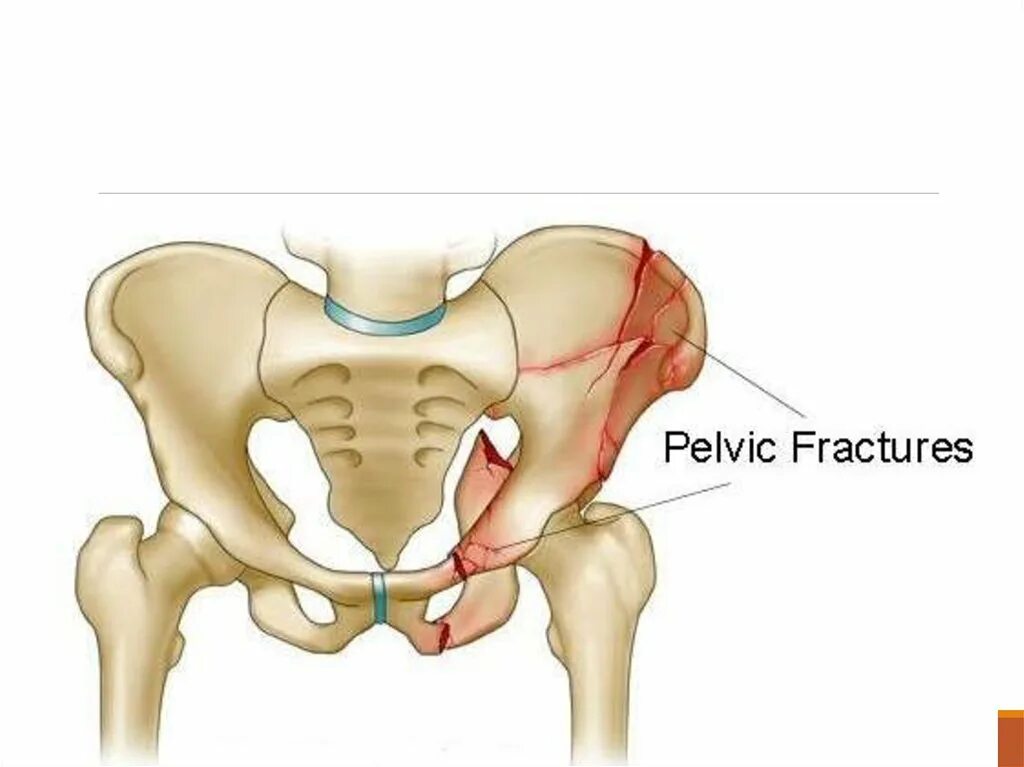 Разрыв кости. Перелом тазовой кости лонной кости. Лонная кость таза перелом. Ушиб подвздошной кости таза. Перелом гребня подвздошной кости.