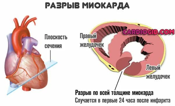 Инфаркт миокарда межжелудочковой перегородки. Инфаркт миокарда разрыв сердца. Инфаркт миокарда с разрывом. Наружный разрыв сердца. Взять разрыв