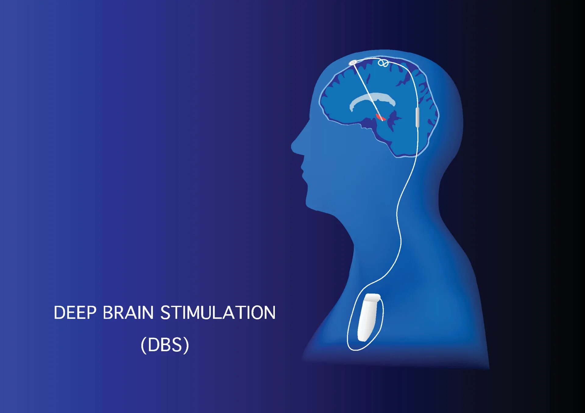 Deep brain. Глубокая стимуляция мозга. ДИИП брайин Стимулейшн. Стимулирует мозг. Стимуляция головного мозга вектор.