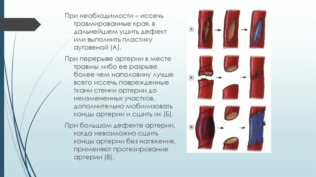 Какой сосуд поврежден. Поврежденные магистральные сосуды. Временное шунтирование артерий.