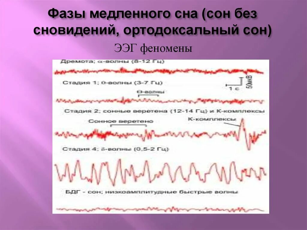 Фазы медленного сна ЭЭГ. Первая фаза сна на ЭЭГ. Ритм ЭЭГ В фазу быстрого сна. Ортодоксальный сон ЭЭГ. Медленные волны на ээг