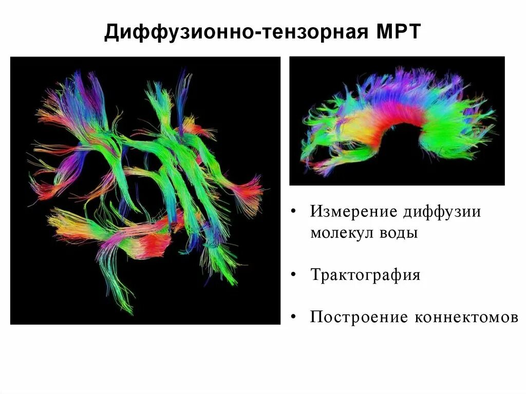 Диффузное мрт. Диффузионно тензорная трактография. диффузионно-тензорная мрт. диффузионная тензорная визуализация. трактография мозга.