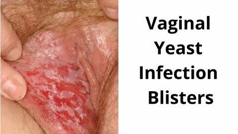 Vaginal yeast infection porn - sys.dogsuniverse.info.