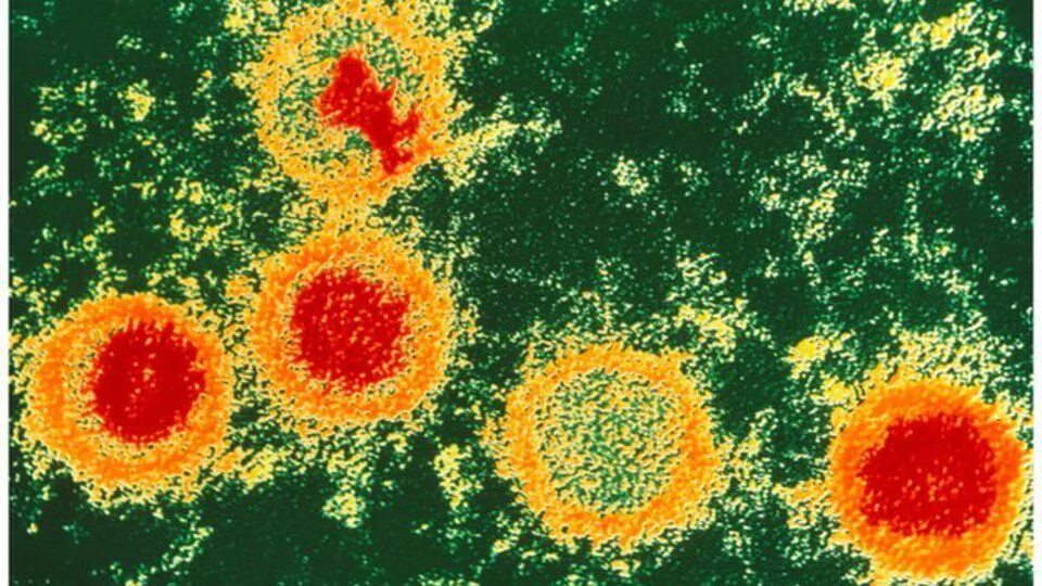 Вирус Эпштейна-Барр под микроскопом. Вирус Epstein Barr virus. Вирус Эпштейна-Барр микроскоп. Вирус Эпштейна Барр микроскоб.