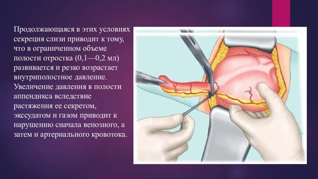 После аппендицита сколько нельзя поднимать. Симптомы острого аппендицита хирургия. острый аппендицит операция. название операции аппендэктомия. операция аппендэктомия.