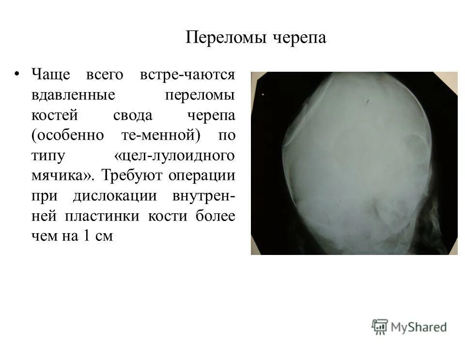 Перелом кости свода черепа. Вдавленный перелом черепа. Вдавленный перелом свода черепа. Вдавленный перелом черепа у ребенка. Перелом костей свода черепа.