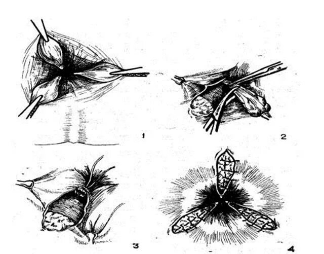 Операции на 4 стадии. Операция Миллигана-Моргана геморроидэктомия. Геморроидэктомия по Миллигану-Моргану. Миллигана Моргана операция геморрой. Геморроидэктомия Лонго.