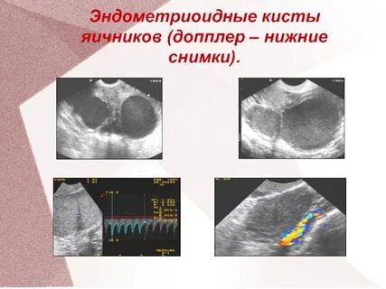 Эндометриоидные кисты отзывы форум