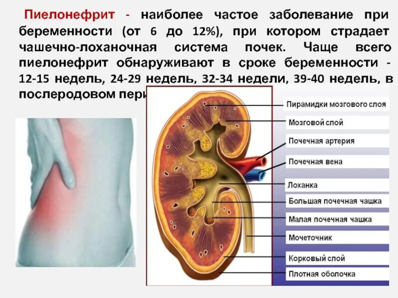 Частые заболевания почек. Пиелонефрит (инфекционное поражение почек). Чашечно лоханочная система при пиелонефрите. Пиелонефрит почек при беременности.