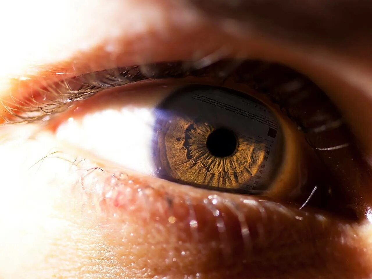 Врожденная колобома радужки. Врожденная колобома радужки. Поликория двойной зрачок. Врожденная колобома радужки. Поплывший зрачок.