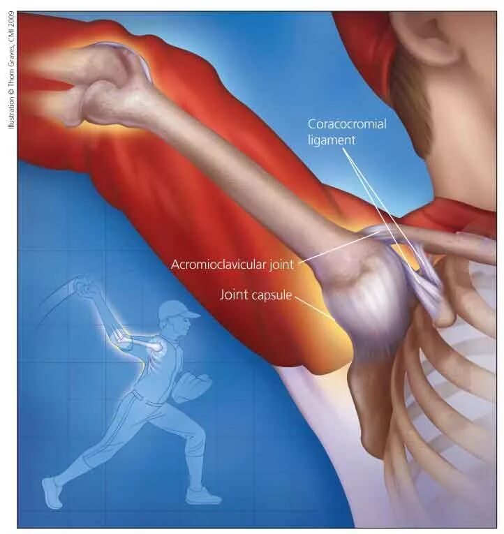 Болит плечо при поднятии. Капсилула поечевого Сус. Разрыв суставной капсулы плечевого сустава. Болит плечо. Растянутые связки плечевого сустава.