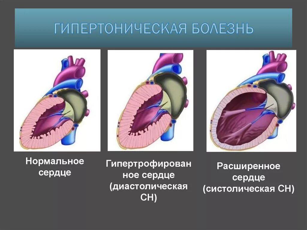 Описание гипертонии. Гипертрофическая болезнь. Гипертоническая болезнь. Нипертоническа ЯБОЛЕЗНЬ. Гипертоническая болезнь сердца.