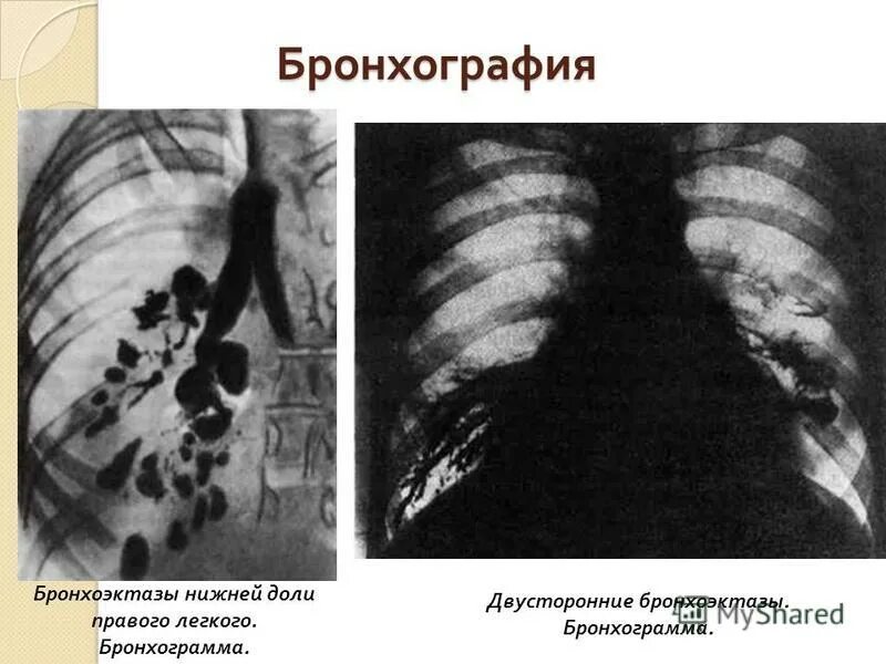 бронхоэктазы нижней доли левого легкого. бронхография цилиндрические бронхоэктазы. бронхоэктазы рентген бронхография. мешотчатые бронхоэктазы кт. бронхоэктазы нижних долей легких.