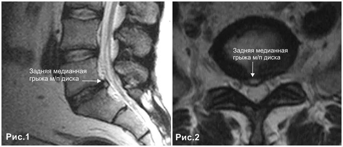 Медианно парамедианная билатеральная. Дорзальная грыжа мрт. Медианная грыжа межпозвонкового диска l5-s1. Медианно-парамедианная грыжа l4-5 диска.
