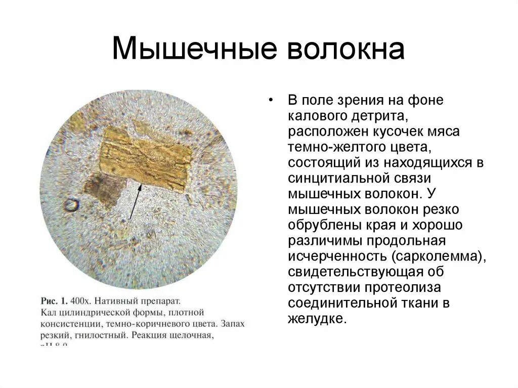 Растительная неперевариваемая клетчатка в кале у взрослого. Мышечные волокна с исчерченностью в микроскопии кала. Копрограмма кала мыечные волокн. Переваренные мышечные волокна в Кале. Переваренные мышечные волокна в Кале у ребенка.