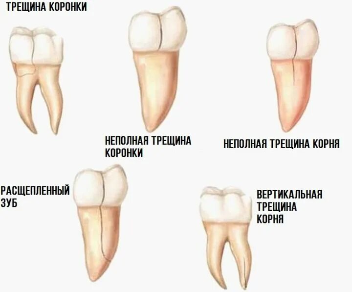 Что делать если зуб раскололс.