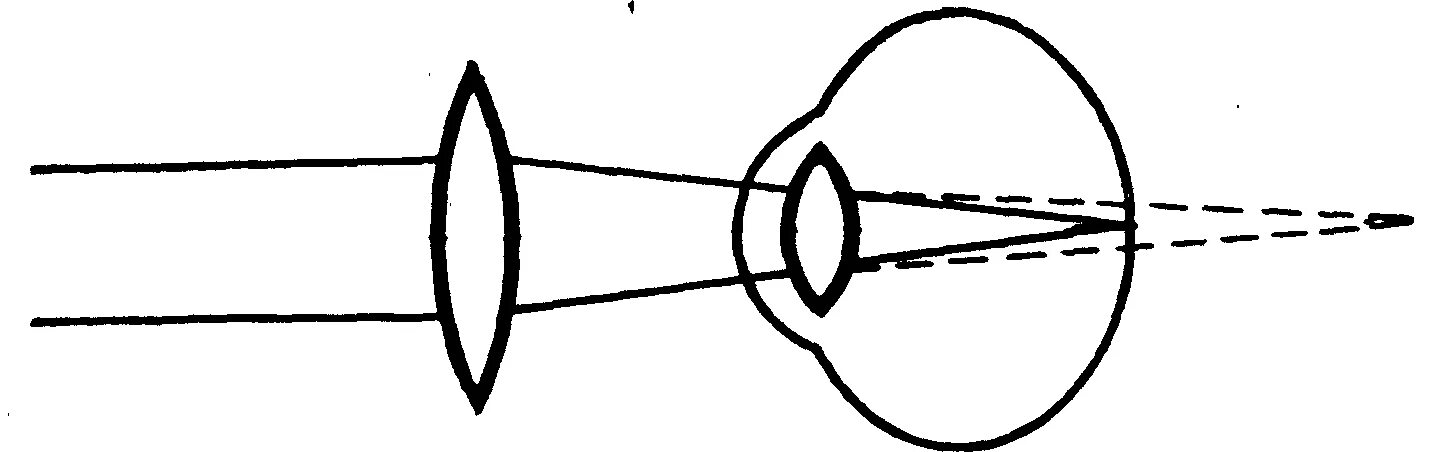 Ход лучей глаза человека. Схема хода параллельного пучка лучей дальнозоркого глаза. Дальнозоркость ход лучей. Дальнозоркость схема хода лучей. Гиперметропический глаз ход лучей.