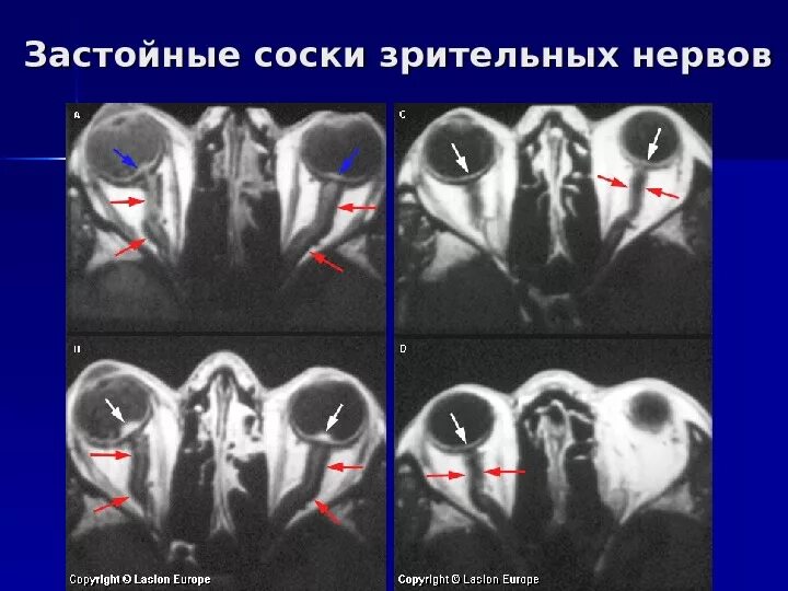 Глазных орбит и зрительных нервов. Поражение зрительного нерва на мрт. Сегменты зрительного нерва на мрт. Невринома зрительного нерва мрт. Расширение периневральных пространств зрительных нервов мрт.