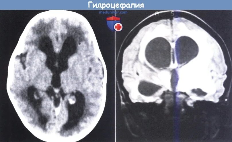 Операция гидроцефалия мозга. Окклюзионная гидроцефалия кт. Заместительная гидроцефалия кт. Наружная гидроцефалия головного мозга кт.