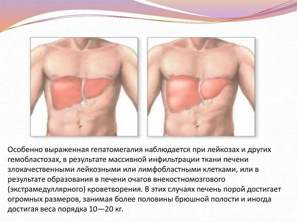 Выраженная гепатомегалия. Гепатомегалия. увеличение размеров печени.
