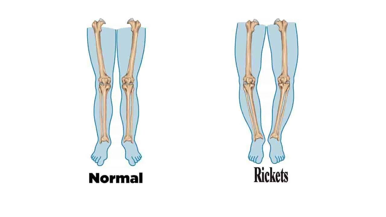 Bow legged. Bow Legs. Bowed Legs. Genu Varum полиомиелит. Переведи legs