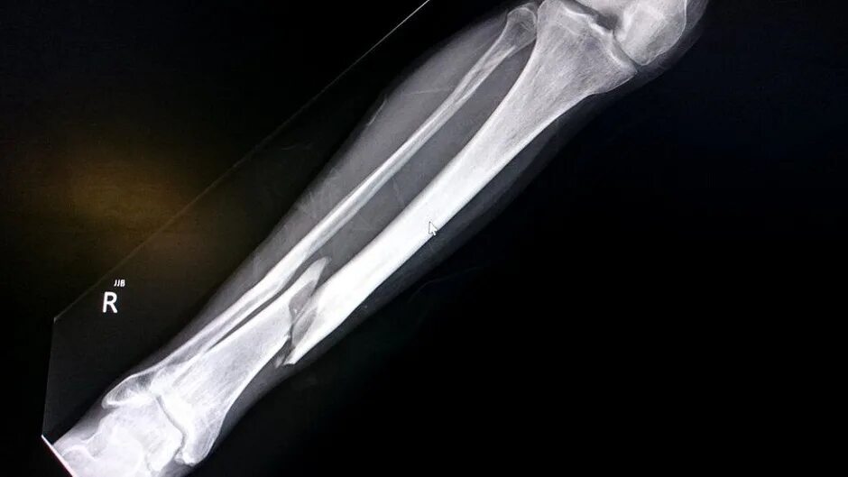 Перелом берцовой кости рентген. Перелом голени рентген. Большеберцовая кость рентген. Перелом костей голени рентген.