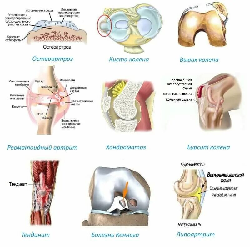 Больные суставы болезнь. Классификация суставов коленный сустав. Болезнь суставов остеоартроз. Заболевания костей и суставов классификация.
