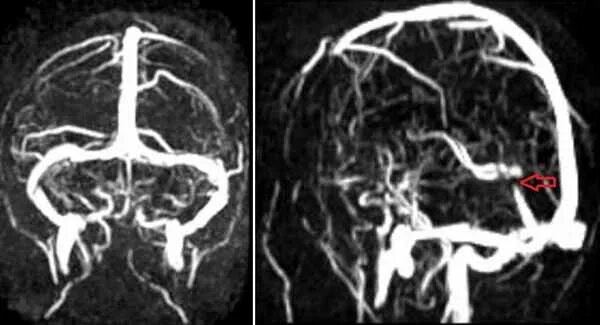 Гипоплазия правой артерии головного мозга. Гипоплазия поперечного синуса мрт. Гипоплазия левого поперечного синуса. Мрт. Тромбоз левого сигмовидного синуса. Гипоплазия поперечного синуса головного мозга.