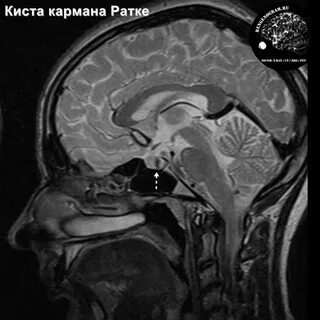 Емізік клиторды тістеу