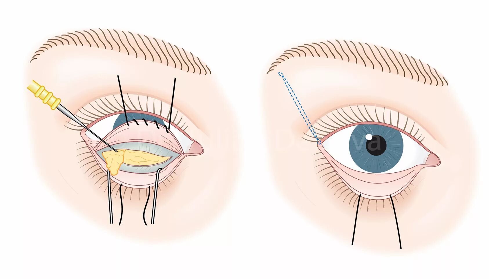 Трансконъюктивальная пластика нижних век. Трансконъюктивальная блефаропластика грыжи. Нижняя блефаропластика трансконъюктивальная. Трансконъюнктивальная блефаропластика верхних век.