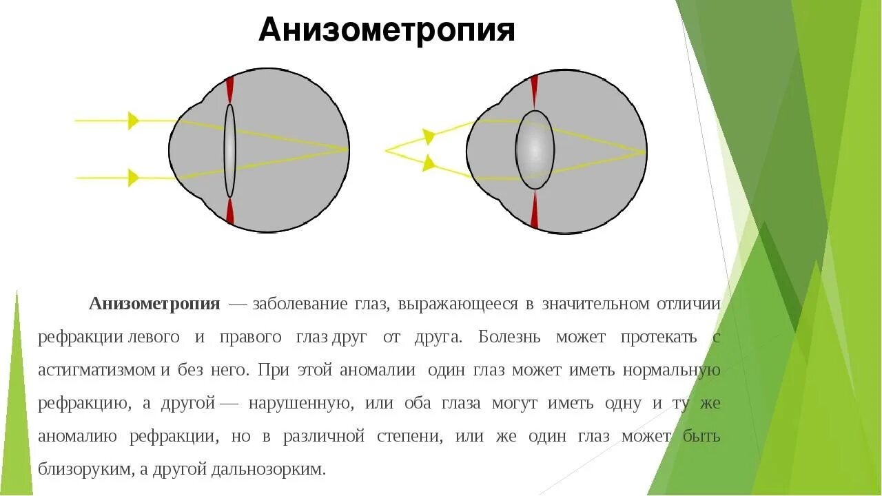 Анизометропия это в офтальмологии