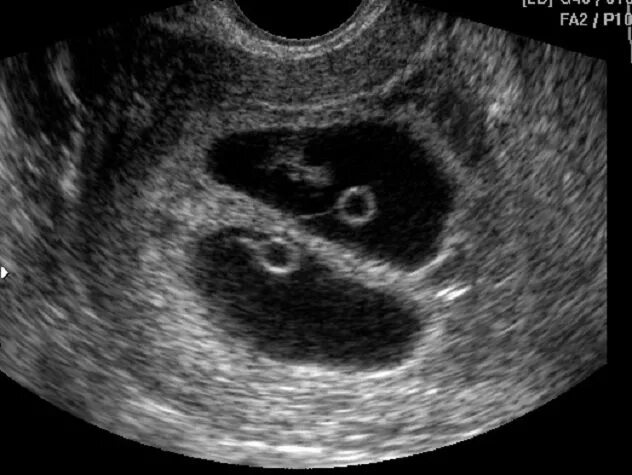 Плодное яйцо с эмбрионом и желточным мешком. Эмбрион на 7 неделе беременности УЗИ. Плодное яйцо и желточный мешок. УЗИ 6 недель беременности двойня.