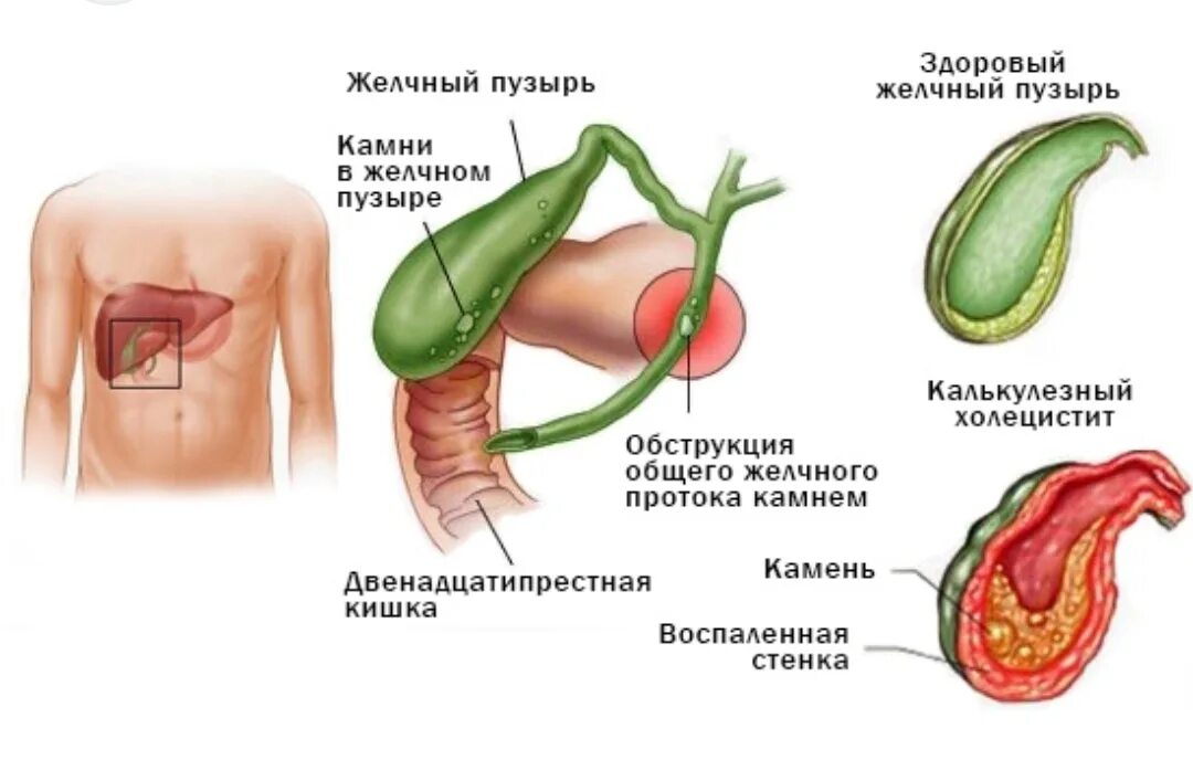 Болит желчный пузырь причины. Желчнокаменная болезнь холецистит. Хронический холецистит рисунок. Болезни желчного пузыря патология. Воспаление желчного пузыря симптомы.