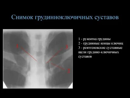Ключичный остеоартроз