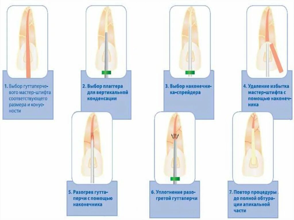Методы пломбирования корневых. Вертикальная конденсация уплотнение гуттаперчи. Методика вертикальной конденсации гуттаперчи этапы. Вертикальная метод обтурации корневых каналов. Вертикальная конденсация корневых каналов методика.