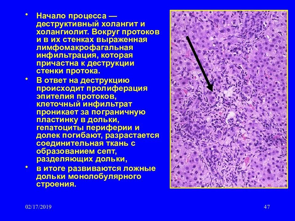 Лимфоидная инфильтрация что это. Пролиферация холангиол. Аденокарцинома поджелудочной гистология. Аденома желчных протоков печени гистология. Макрофагальная инфильтрация гистология.