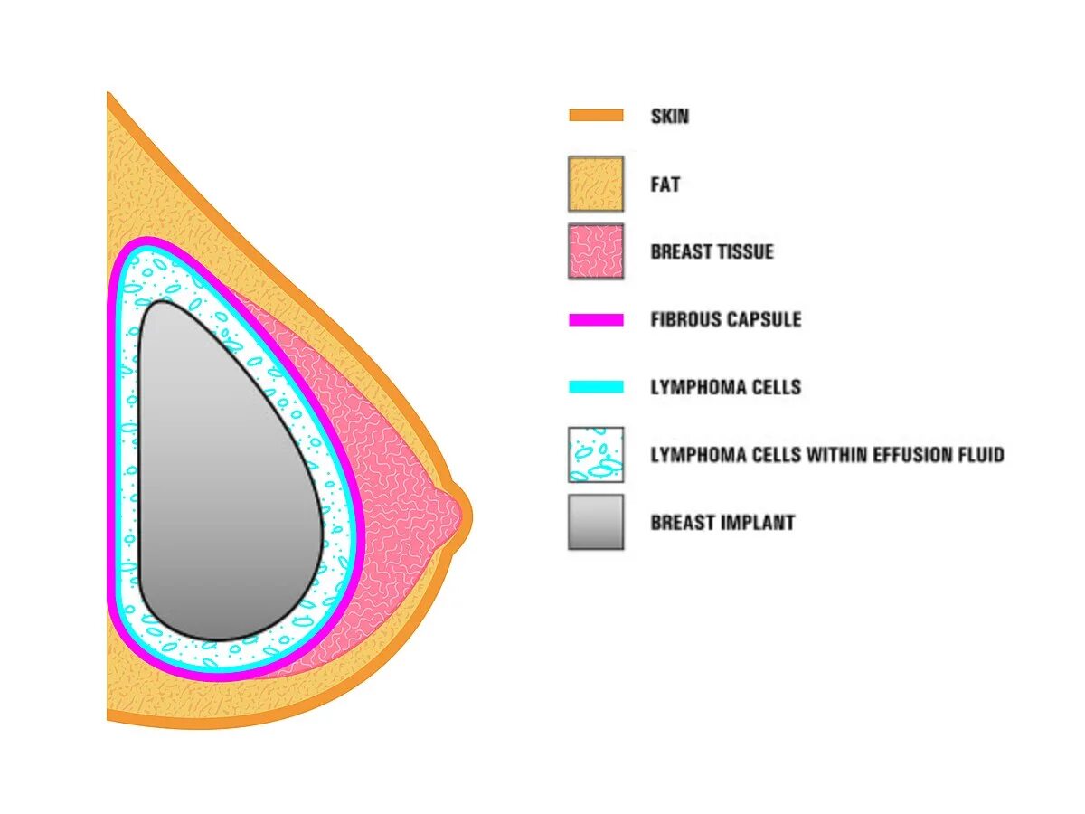 Импланты грудных желез. Имплант молочной железы. Силиконовая грудь в разрезе. Импланты груди виды. Имплант в разрезе грудной.