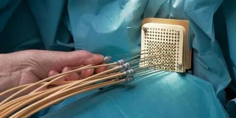 Брахитерапия рака предстательной железы
