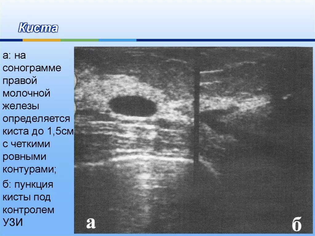 Как отличить кисту. Фиброаденома мол жел УЗИ. УЗИ фиброаденомы правой молочной железы. Кистозная фиброаденома молочной железы. Кисты и фиброаденомы молочной железы.
