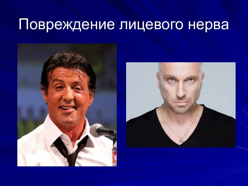 Повреждение нервов лица. Повреждение нервов лица